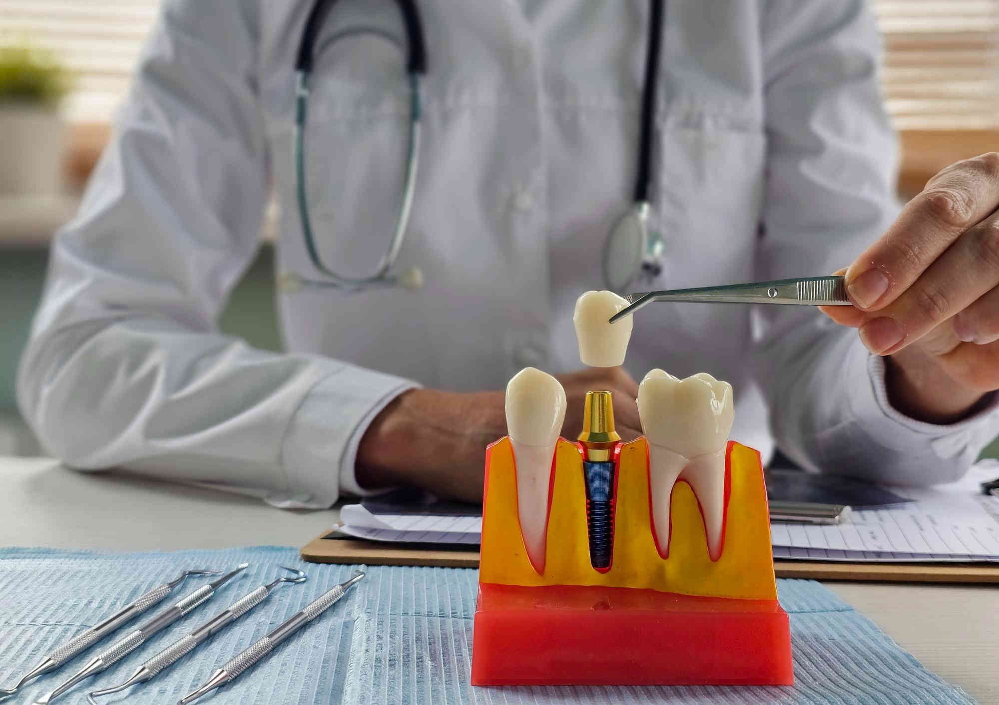 Stomatolog przedstawia jak działa wszczepienie implantu zębowego